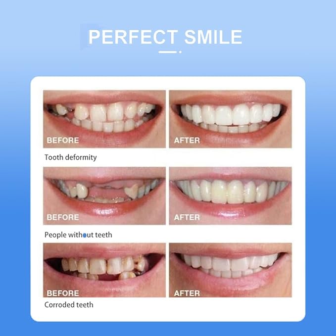 Snap On Smile Braces Teeth Kit For Men & Women